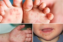 Tăng cường công tác phòng, chống bệnh Tay chân miệng