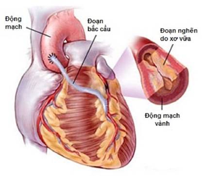 Lần đầu phẫu thuật tim mạch không cần chẻ xương ức