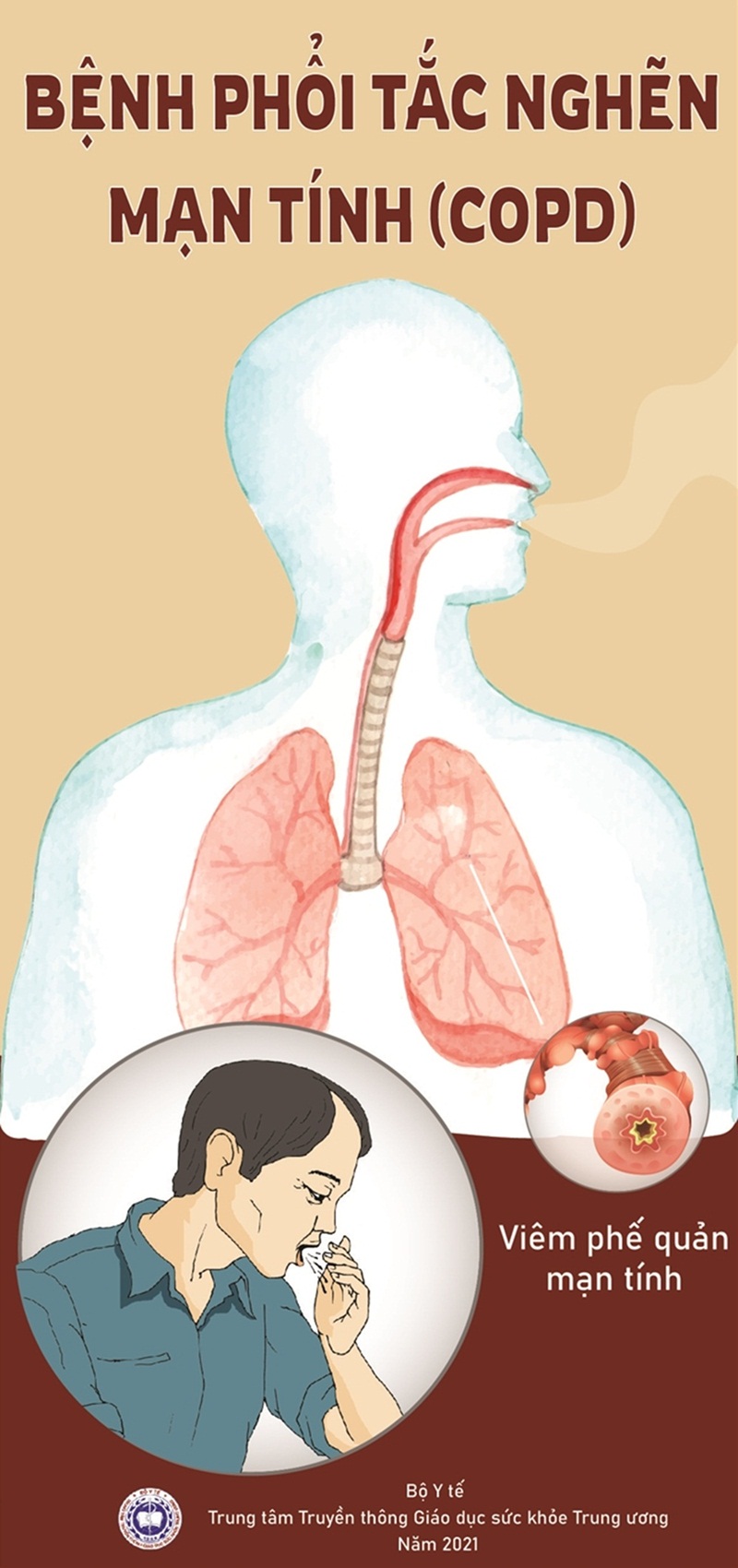 Bệnh phổi tắc nghẽn mạn tính (COPD))