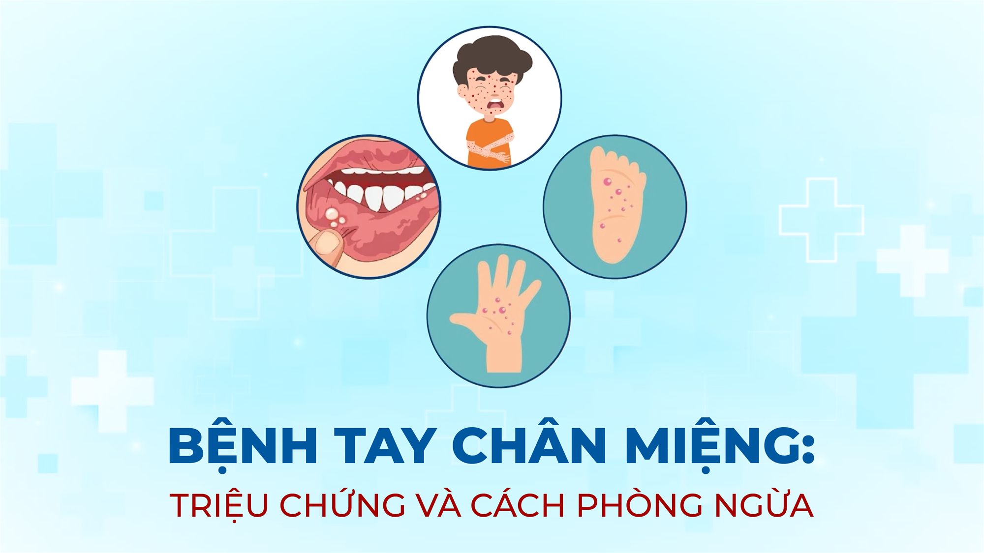 Bệnh tay chân miệng: triệu chứng và cách phòng ngừa