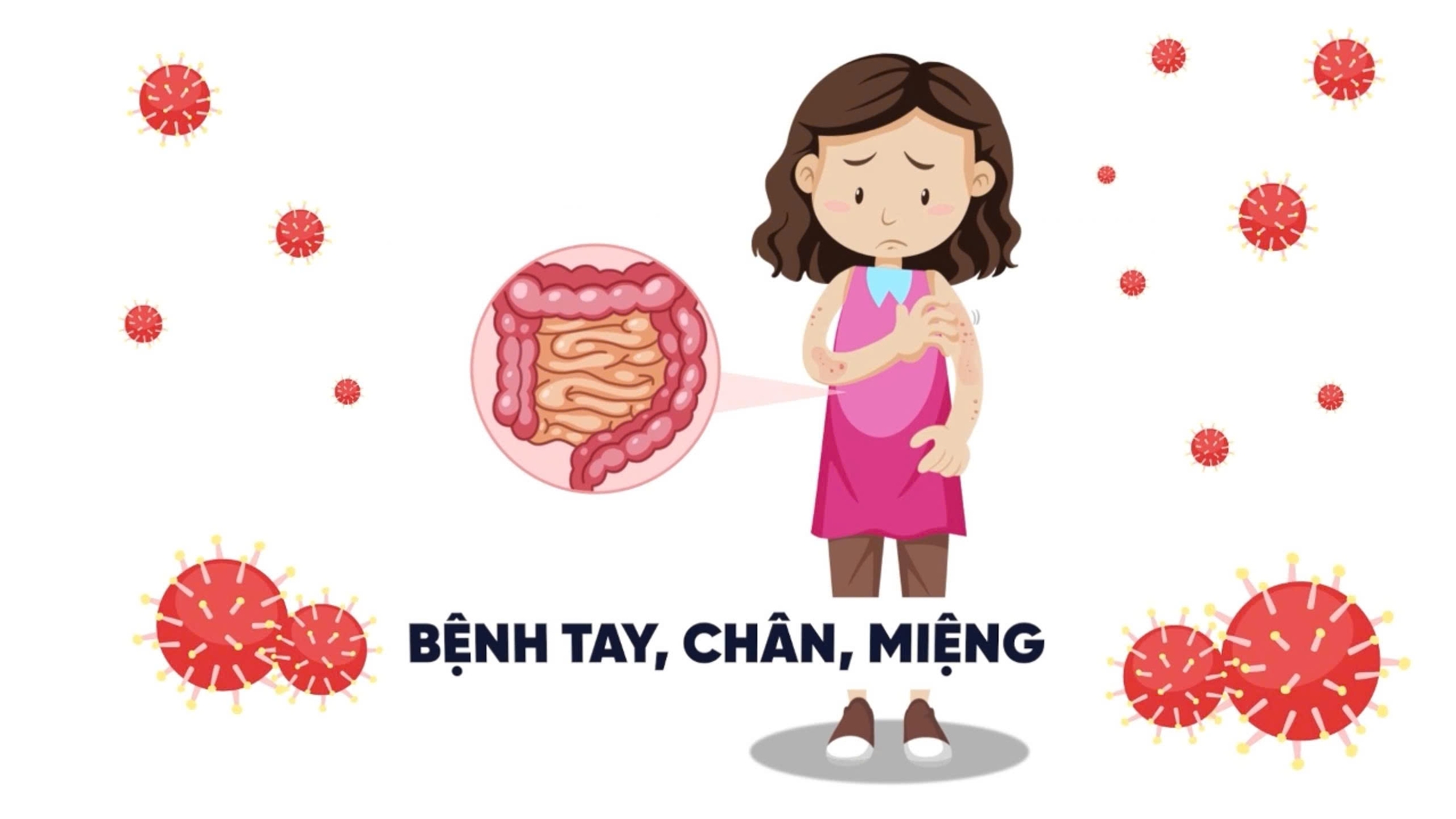 Bệnh tay chân miệng: triệu chứng và cách phòng ngừa