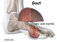 Bệnh Gout - cần tuân thủ theo phác đồ điều trị