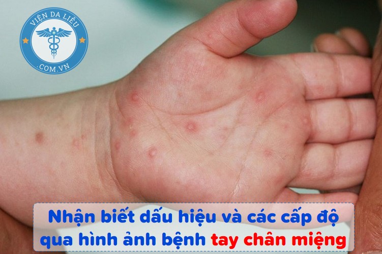 Bộ Y tế yêu cầu tăng cường thu dung, điều trị ca mắc tay chân miệng