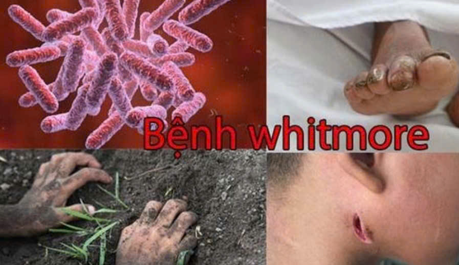 Bệnh Whitmore - những điều cần lưu ý